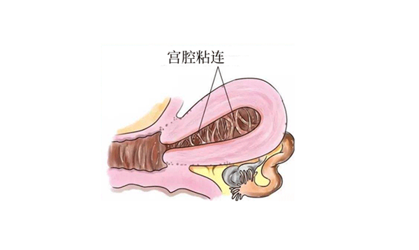 连云港49岁试管助孕：为什么宫颈粘连不能直接做试管婴儿，看完你就知道了(图1)